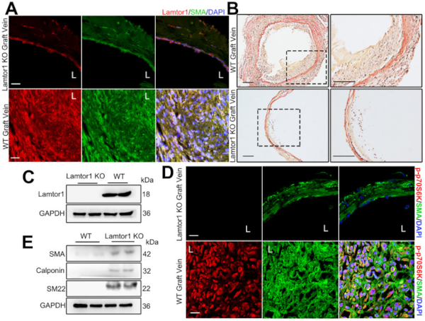 周期性张应变通过移植静脉中的 circSlc8a1/miR-20a-5p 轴调节 Lamtor1 并促进内膜增生